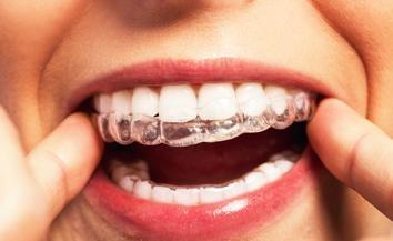 A person holding her Invisalign Clear Aligners.