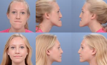 profile pictures of a patient with an orthodontic condition.