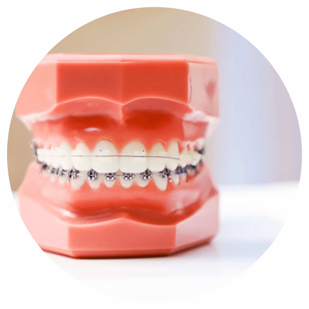types of orthodontic appliances